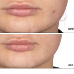 NIP+FABRetinol Fix Retinol Fix Blemish Gel 15 ml
