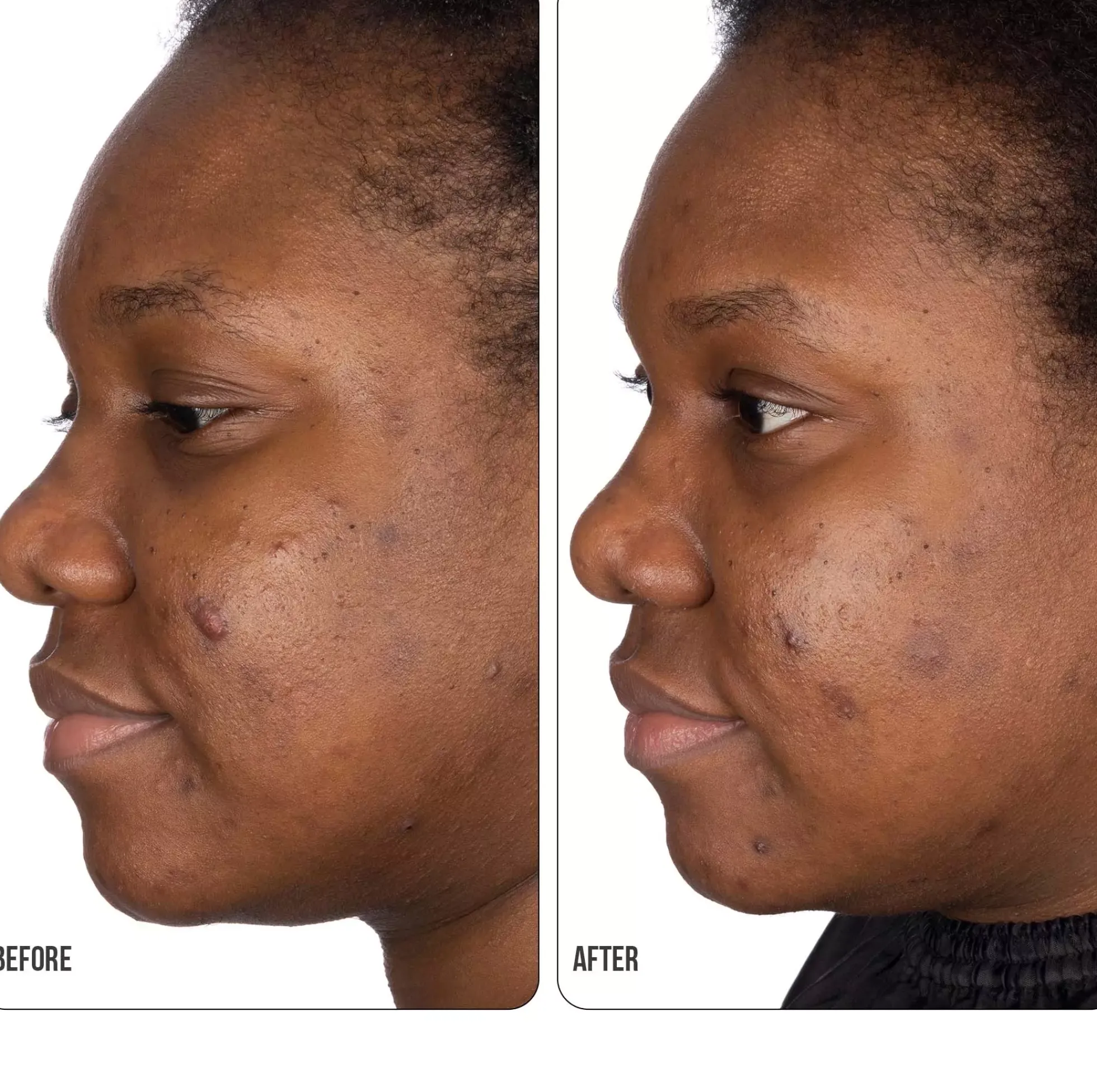 NIP+FABRetinol Fix Retinol Fix Blemish Gel 15 ml