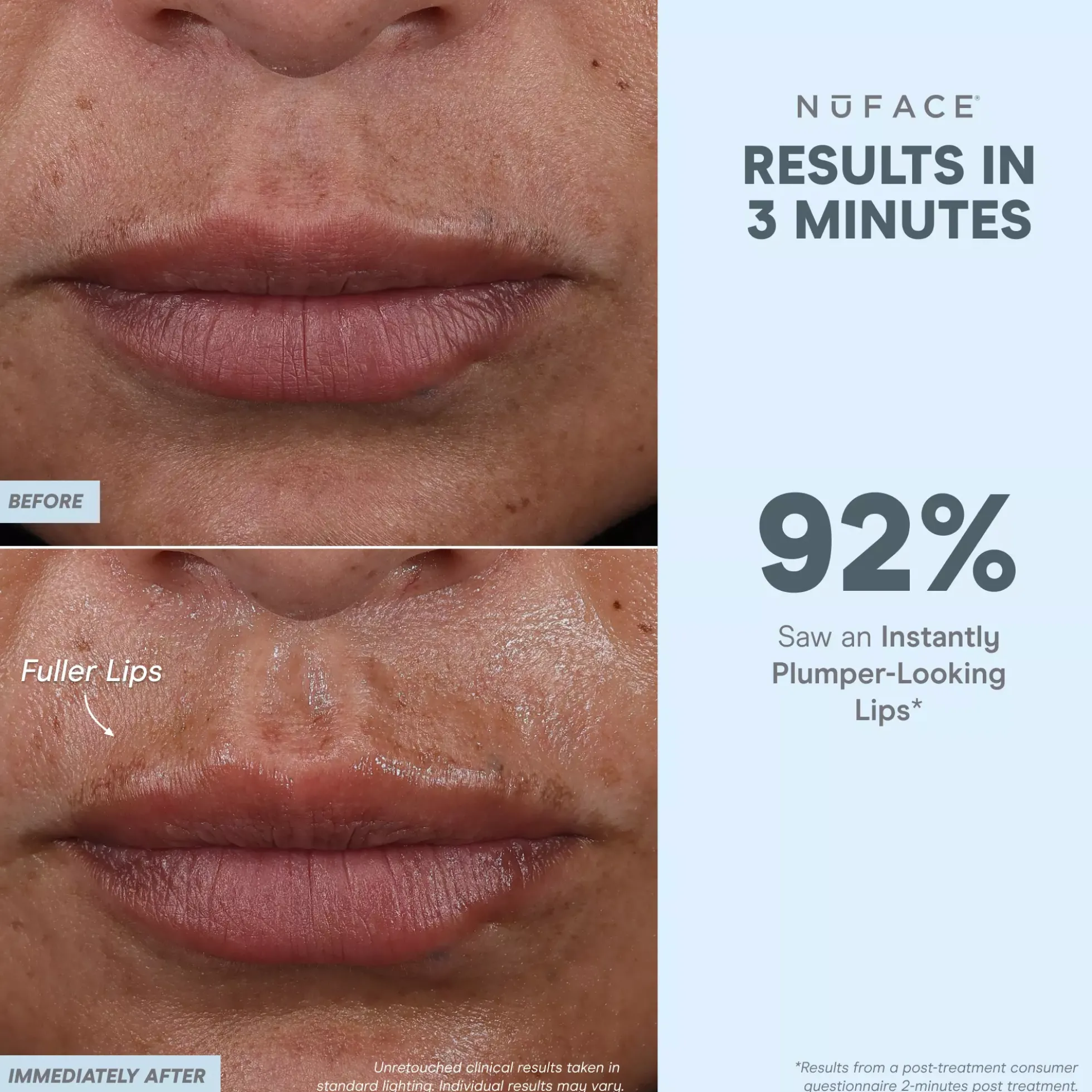 NuFACE FIX MicroWand