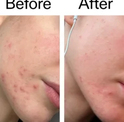 The Inkey List Blemish Clearing Moisturizer 2% Novoretin 50 ml